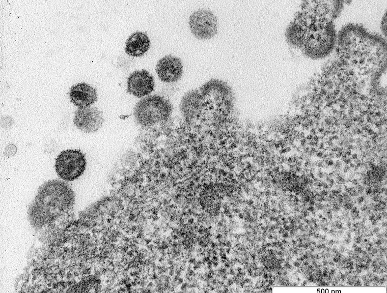 Маленькие шарики, которые отрываются от клетки, — это и есть ВИЧ, выходящий из нее. Какие-то вирусы полностью отделились, какие-то только в процессе
