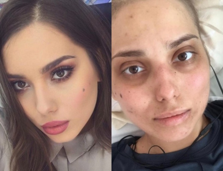 На первом фото Ольга Фарфанюк в самом начале лечения, на втором — во время прохождения химиотерапии. Эти фотографии поразили пользователей соцсетей.