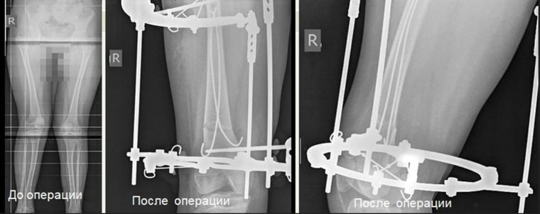 Операцию провели 12-летней девочке