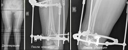 Операцию провели 12-летней девочке