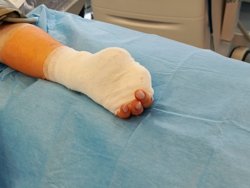 Югорчанка лишилась пальцев из-за удара током в ванне