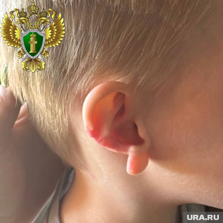  Ребенку причинена неизгладимая травма в виде травматической ампутации