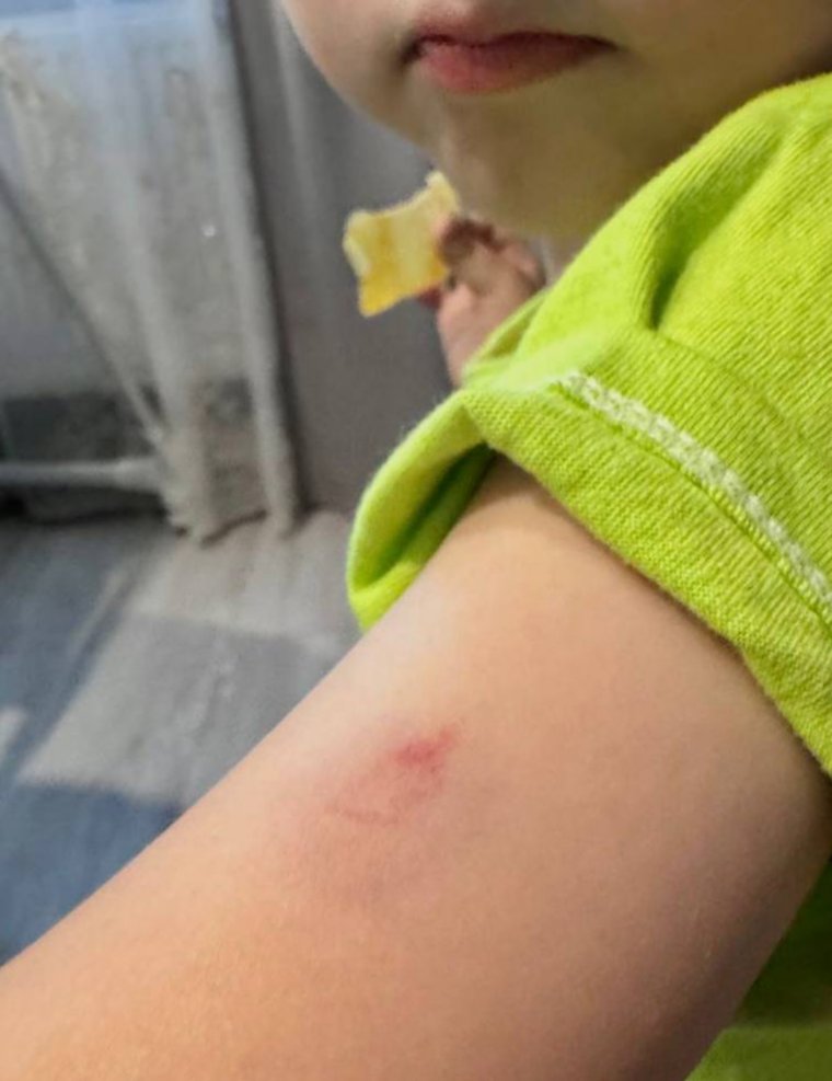По мнению врачей, синяк поставлен намеренно