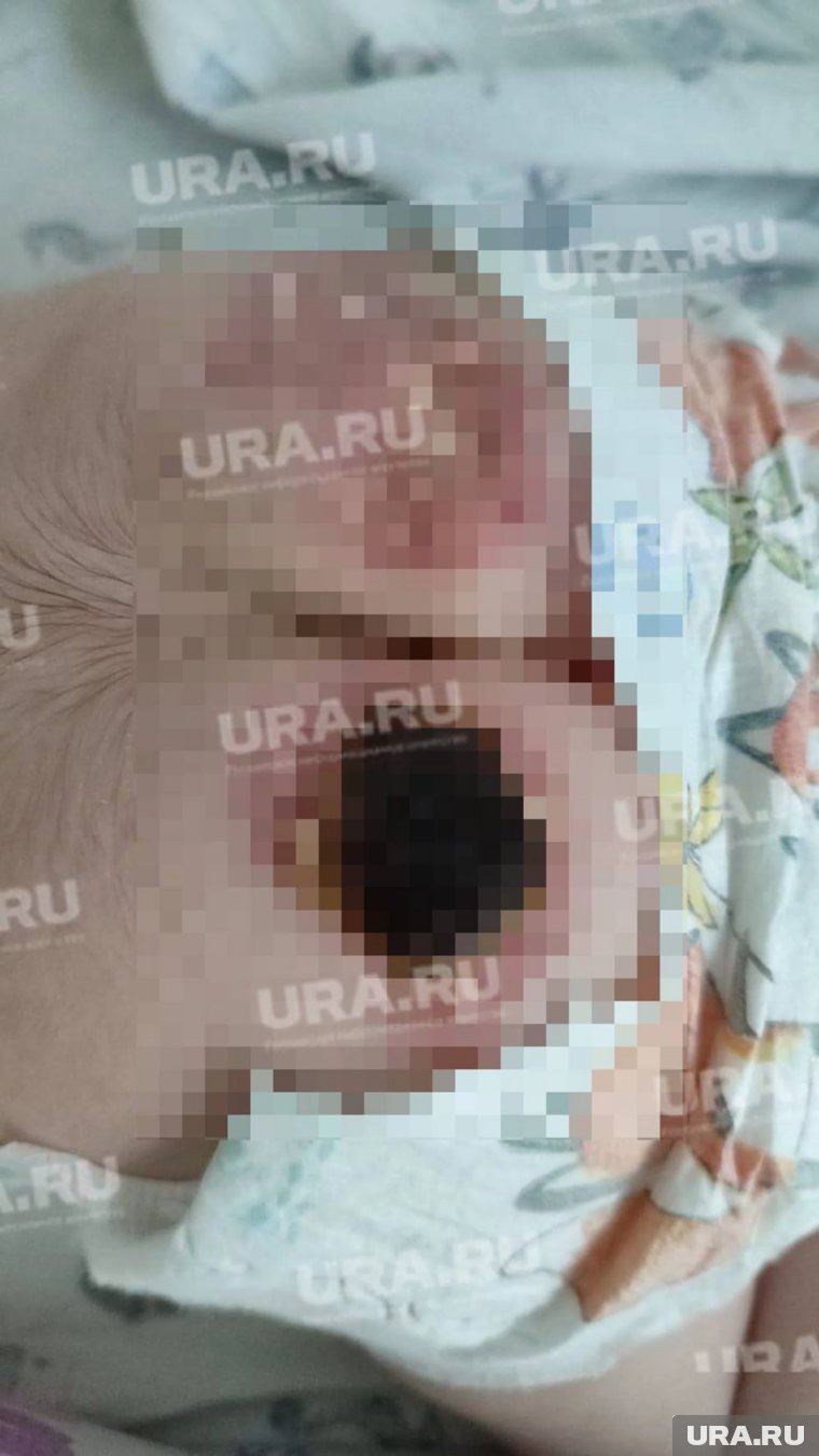 У ребенка зафиксированы серьезные термические повреждения кожи