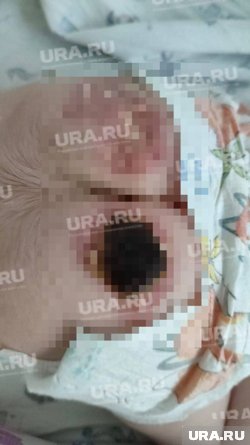 У ребенка зафиксированы серьезные термические повреждения кожи