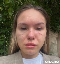 Девушка получила сотрясение мозга и теперь страдает от головной боли