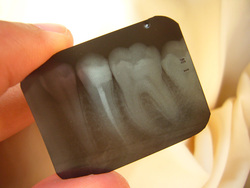 Открытая лицензия от 25.08.2015. Зубы , зубы, рентген