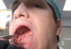 Рустам Яхьяев хладнокровно проводит болезненное удаление зуба