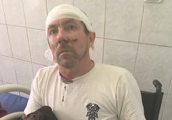 Уральского активиста покалечил охранник с лопатой