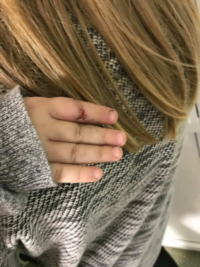 Двухлетней девочке едва не оторвало палец