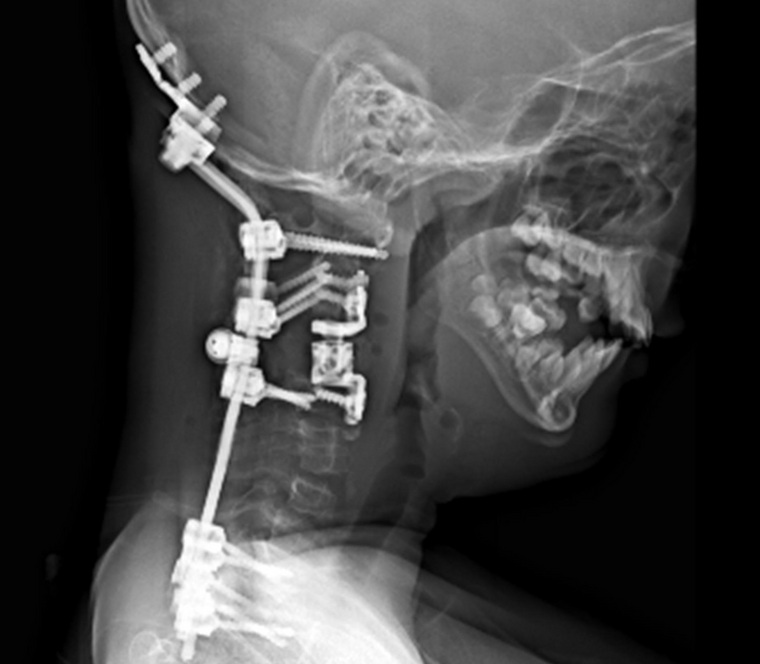 Пациенту установили двойную фиксирующую металлоконструкцию в шейном отделе позвоночника