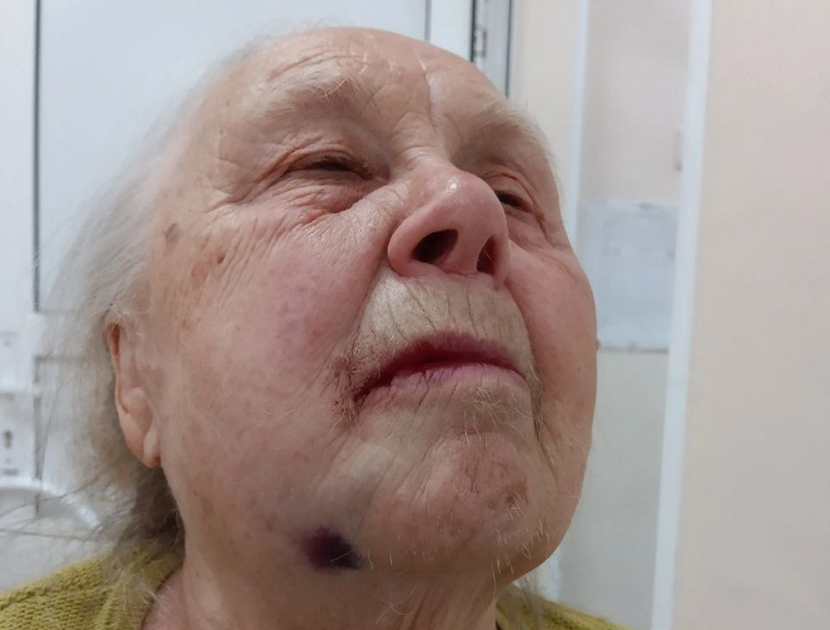 Бабушке долго не могли вырвать зуб мудрости и в итоге направили в госпиталь ветеранов ВОВ
