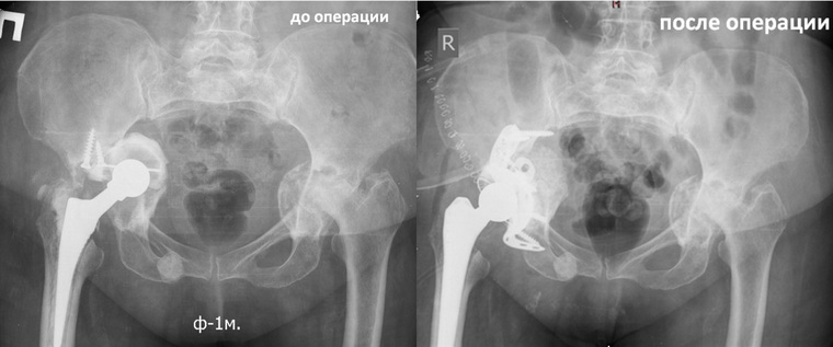 Фото «до» и «после» операции врачей центра Илизарова