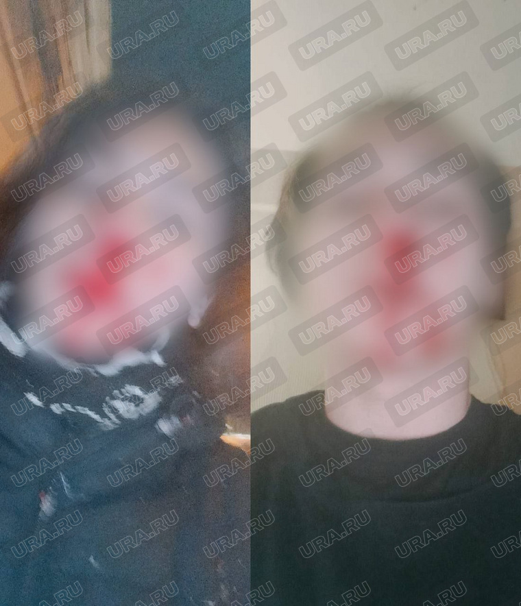 После нападения толпы подростков лицо парня было в крови