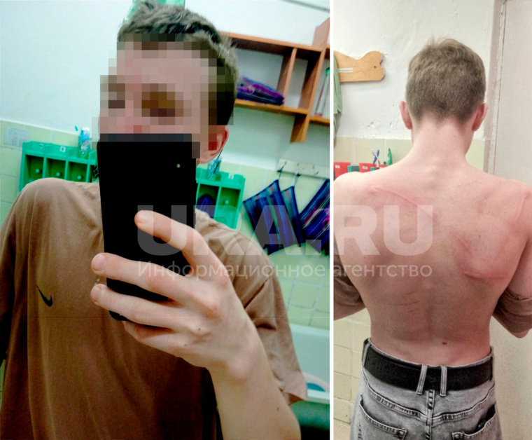 Мальчику оставили фингал и исцарапали спину